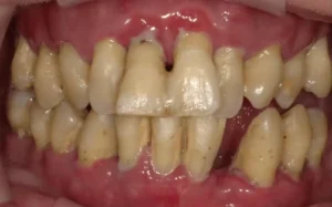 Dentist-Toa-Payoh-Gum-Disease